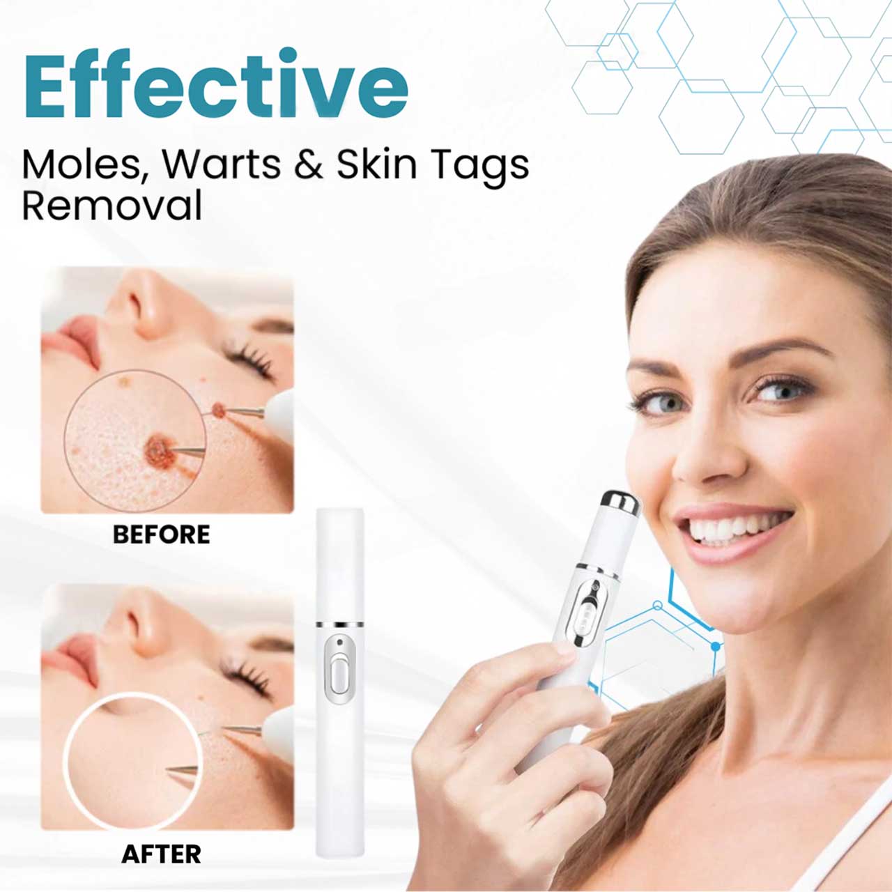 HZA® Non-Invasive Mole and Wart Removal Laser Pen(⏰Limited Time Discount⏰)