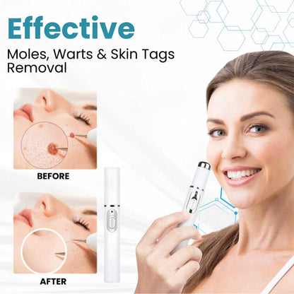 HZA® Non-Invasive Mole and Wart Removal Laser Pen(⏰Limited Time Discount⏰)