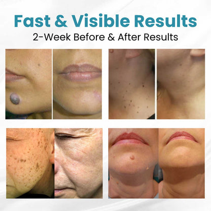 HZA® Non-Invasive Mole and Wart Removal Laser Pen(⏰Limited Time Discount⏰)