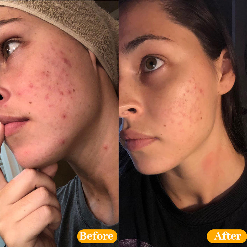 Newyuo™ Acne Foaming Cream Cleanser, 10% Benzoyl Peroxide Face Wash With Hyaluronic Acid, Niacinamide