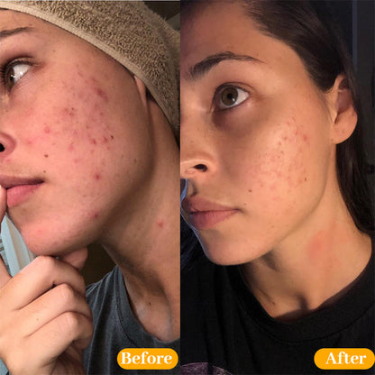 Newyuo™ Acne Foaming Cream Cleanser, 10% Benzoyl Peroxide Face Wash With Hyaluronic Acid, Niacinamide