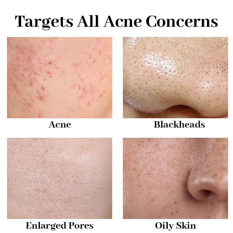 Newyuo™ Acne Foaming Cream Cleanser, 10% Benzoyl Peroxide Face Wash With Hyaluronic Acid, Niacinamide