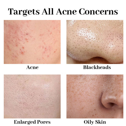 Newyuo™ Acne Foaming Cream Cleanser, 10% Benzoyl Peroxide Face Wash With Hyaluronic Acid, Niacinamide